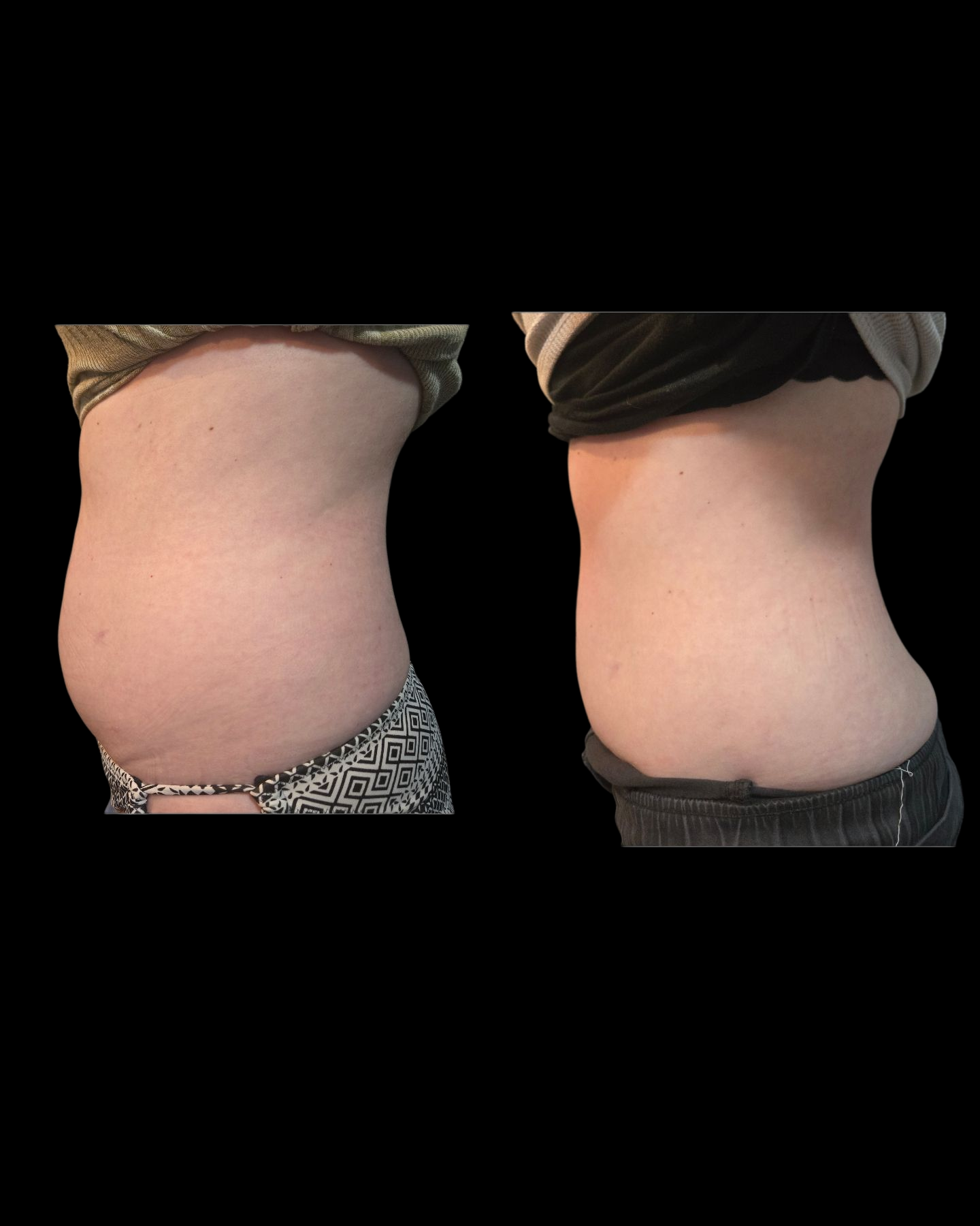 Emsculpt NEO Results 10